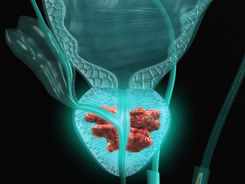 Prostatitis